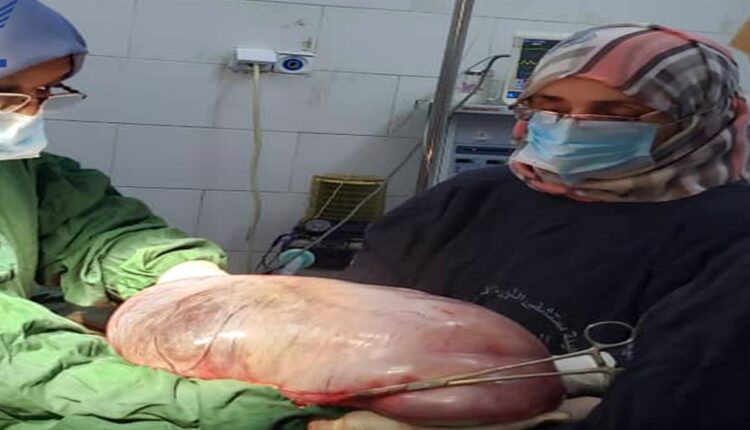 عملية جراحية تزيل ورم وزنه 10 كيلو جرام من بطن امرأة في الحديدة