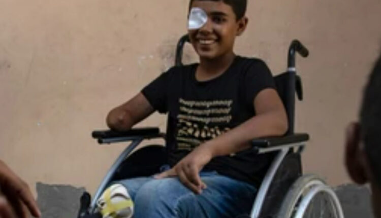 أطباء غزة يبترون أطراف الجرحى لإنقاذ حياتهم