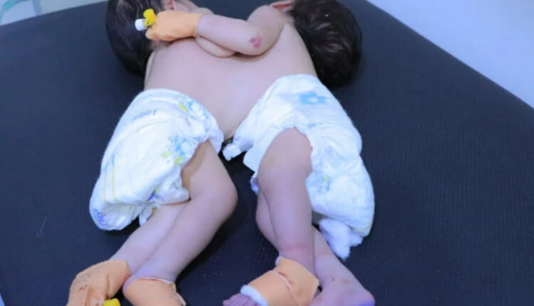 الصحة اليمنية تحمل السعودية والمنظمات الدولية مسؤولية وفاة طفل توأم سيامي